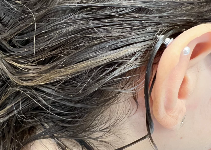 Bambina con infestazione di pidocchi dietro le orecchie