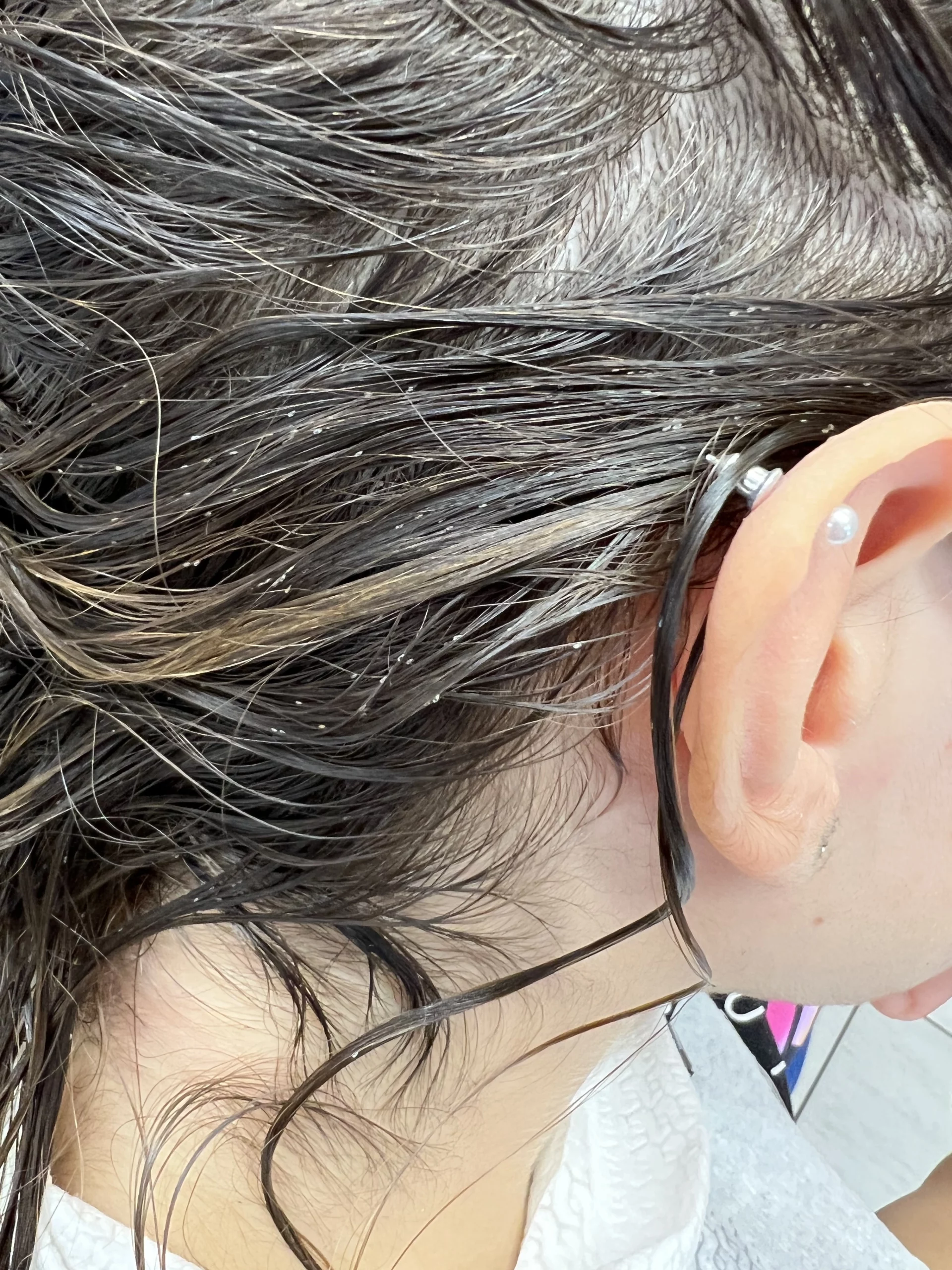 Bambina con infestazione di pidocchi dietro le orecchie